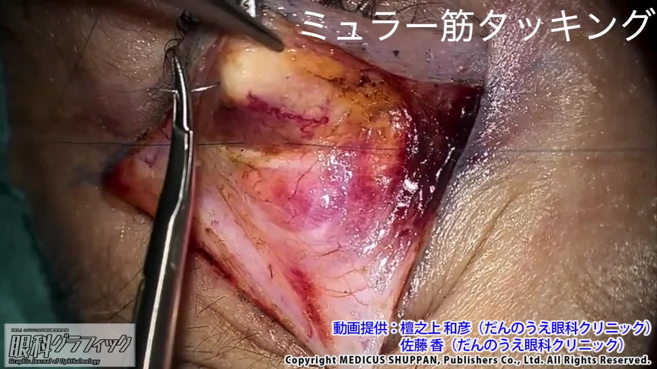 眼科グラフィック 2020年1号(第9巻1号)特集:緑内障検査 キホンの「キ」からPPG診療まで / 最新常識! アレルギー治療薬の正しい使い方 / さあどうする! 眼外傷の緊急処置手術 m3電子書籍 | 眼科グラフィック2022年増刊 白内障手術