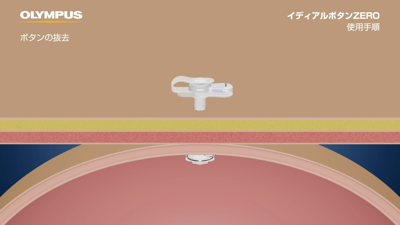 交換用胃瘻カテーテル 胃留置型・バンパー型・ガイドワイヤーあり イ